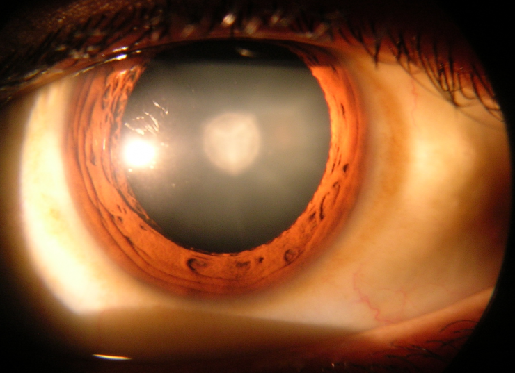 cataract eye health